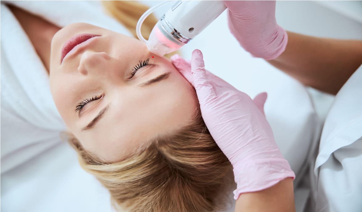 PRP and microneedling facial treatment in progress at La Miel Aesthetics in Raleigh.